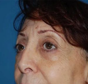 after eyelid lift close angle view female case 4902