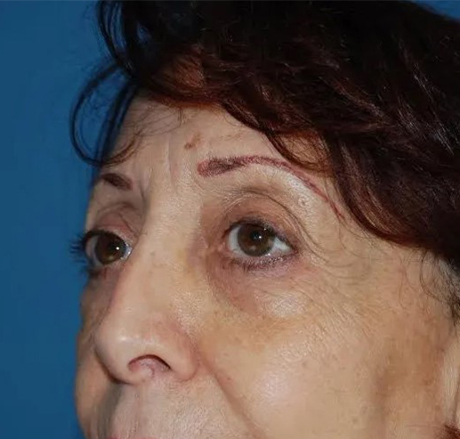 after eyelid lift close angle view female case 4902