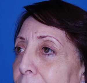 before eyelid lift close angle view female case 4902