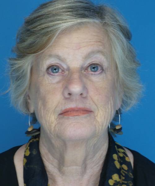 before facelift front view female patient case 1384