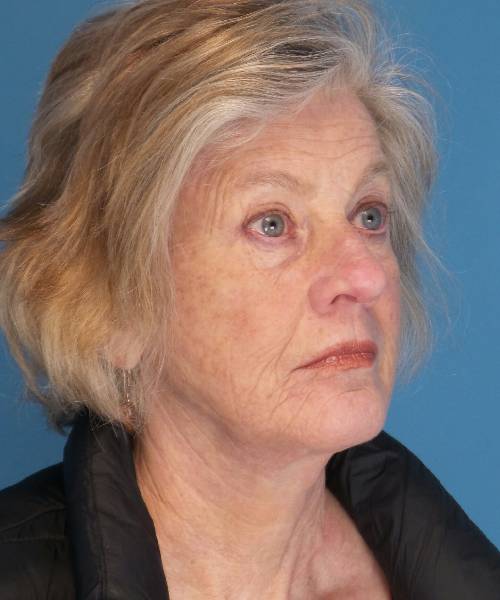 after facelift right angle view female patient case 1384