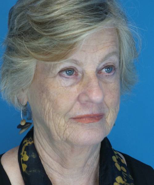 before facelift right angle view female patient case 1384