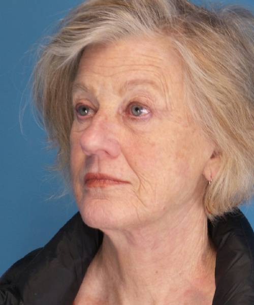 after facelift left angle view female patient case 1384
