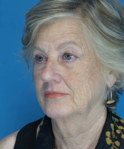 before facelift left angle view female patient case 1384