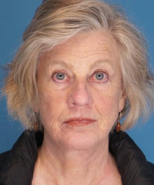 after facelift front view female patient case 1384