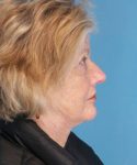 after facelift right side view female patient case 1384