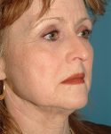 before facelift female patient right angle view case 1913