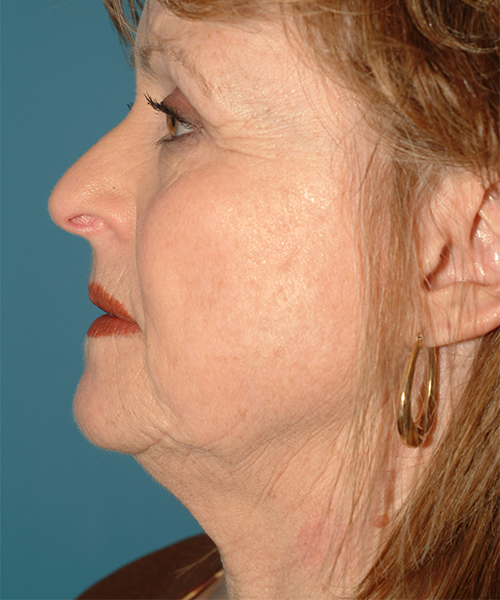 before facelift female patient left side view case 1913