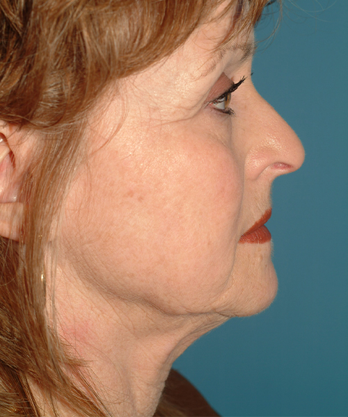 before facelift female patient right side view case 1913