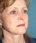 after facelift female patient right angle view case 1913