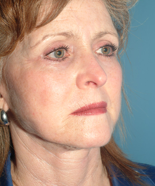 after facelift female patient right angle view case 1913