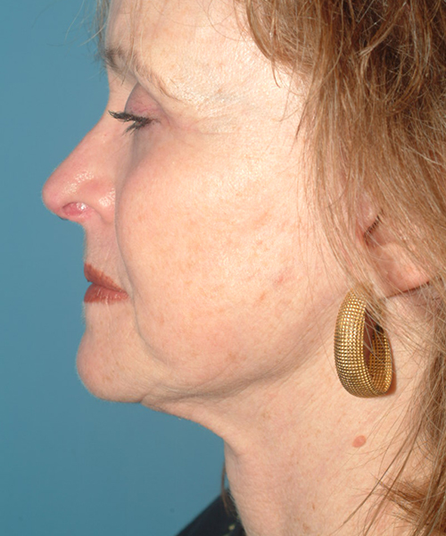 after facelift female patient left side view case 1913