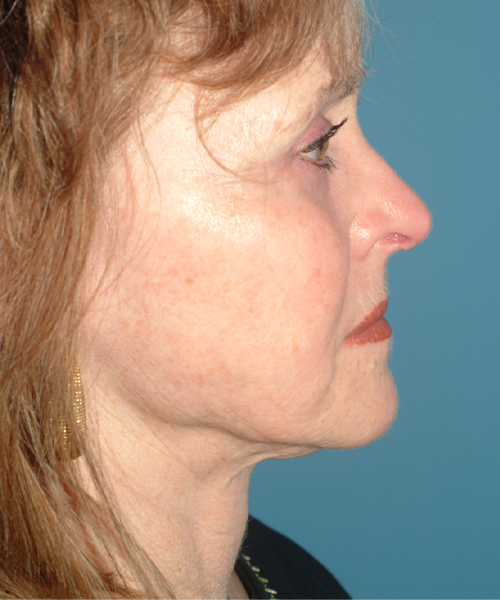 after facelift female patient right side view case 1913