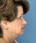 before facelift female patient right side view case 1925