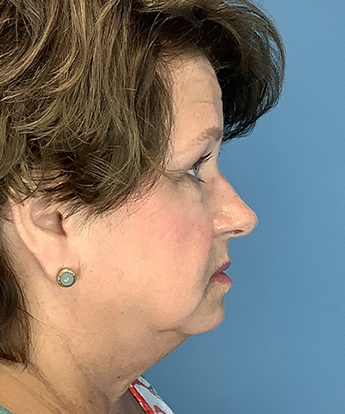 before facelift female patient right side view case 1925
