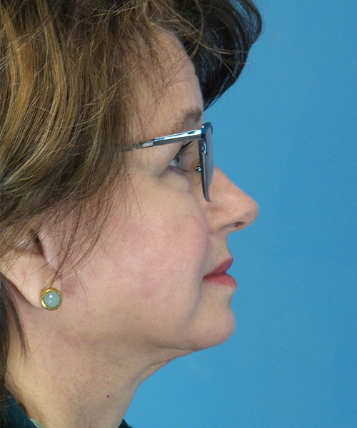 after facelift female patient right side view case 1925