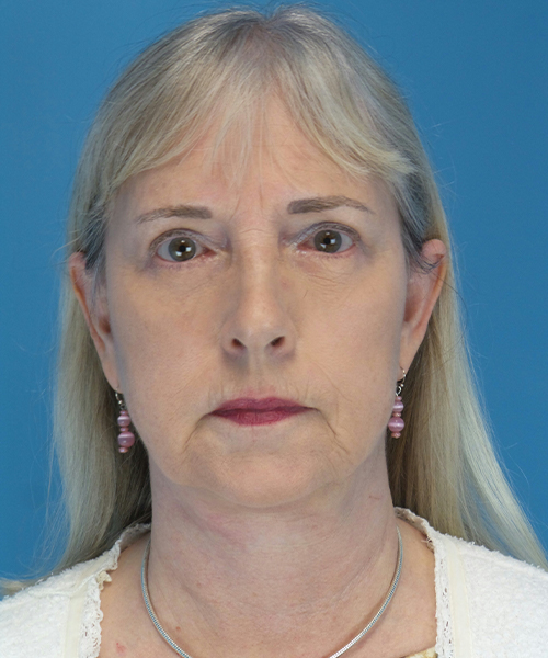 after facelift female patient front view case 1936