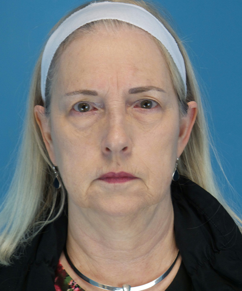 Before facelift female patient front view case 1936