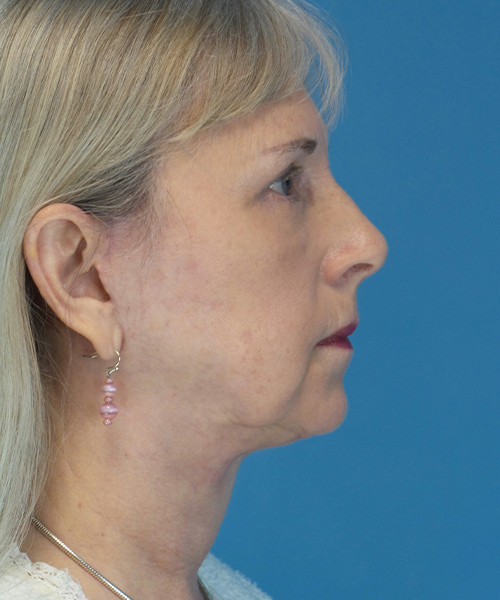 after facelift female patient right side view case 1936