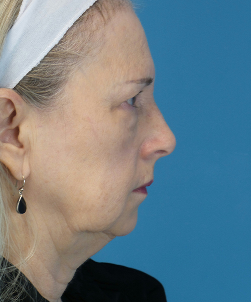 before facelift female patient right side view case 1936