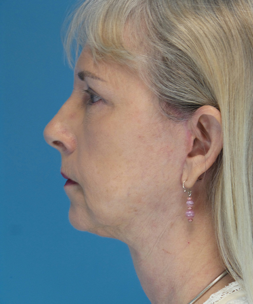 after facelift female patient left side view case 1936