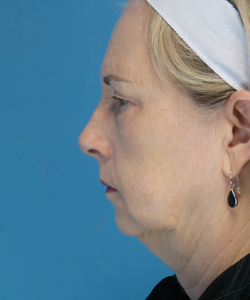 before facelift female patient left side view case 1936