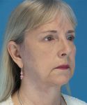 after facelift female patient right angle view case 1936