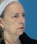 before facelift female patient right angle view case 1936