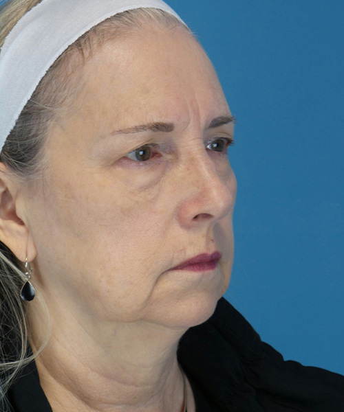 before facelift female patient right angle view case 1936