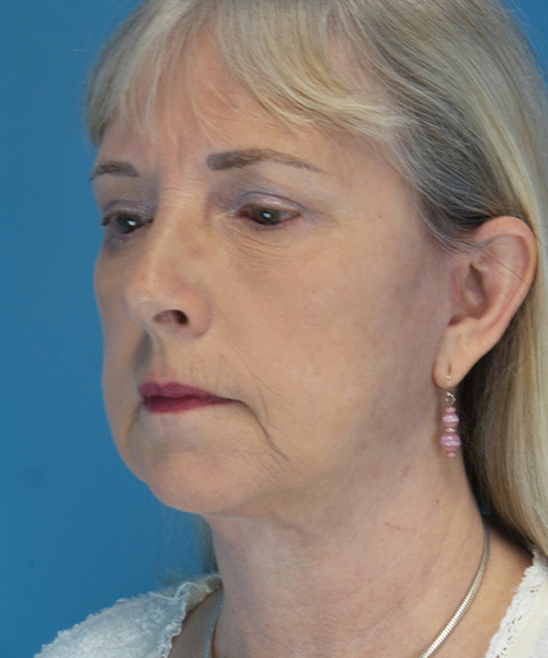 after facelift female patient left angle view case 1936