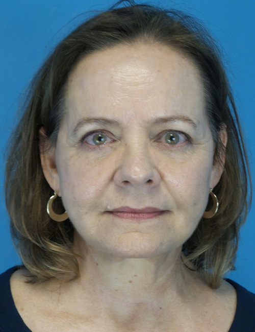 after facelift female patient front view case 4416 | Crispin Plastic Surgery Atlanta, GA