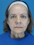 before facelift female patient front view case 4416 | Crispin Plastic Surgery Atlanta, GA