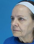 before facelift female patient front left diagonal view case 4416 | Crispin Plastic Surgery Atlanta, GA