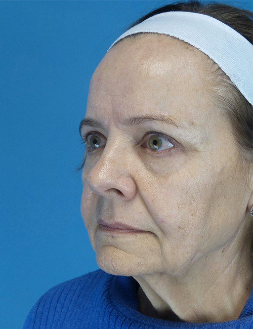 before facelift female patient front left diagonal view case 4416 | Crispin Plastic Surgery Atlanta, GA