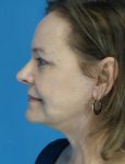 after facelift female patient left side view case 4416 | Crispin Plastic Surgery Atlanta, GA