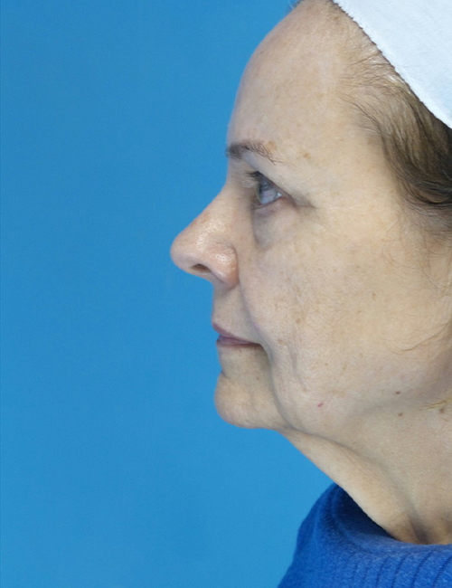 before facelift female patient left side view case 4416 | Crispin Plastic Surgery Atlanta, GA