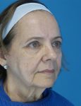 before facelift female patient front right diagonal view case 4416 | Crispin Plastic Surgery Atlanta, GA