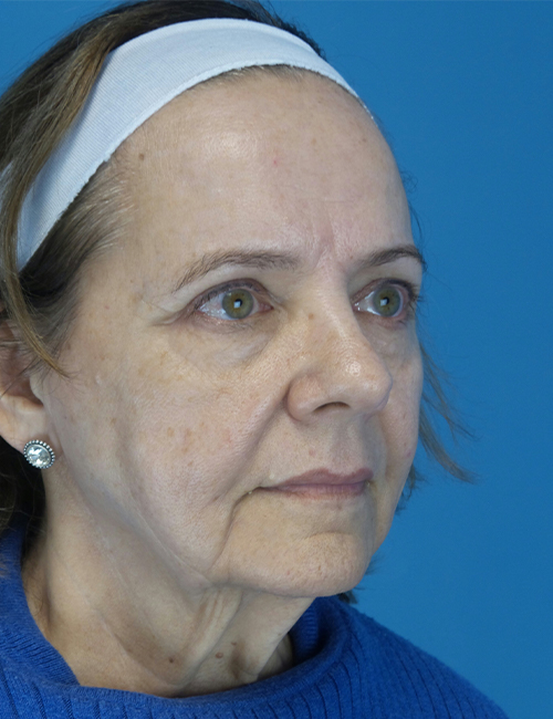 before facelift female patient front right diagonal view case 4416 | Crispin Plastic Surgery Atlanta, GA