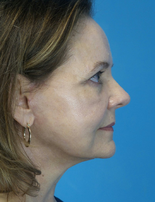 after facelift female patient right side view case 4416 | Crispin Plastic Surgery Atlanta, GA