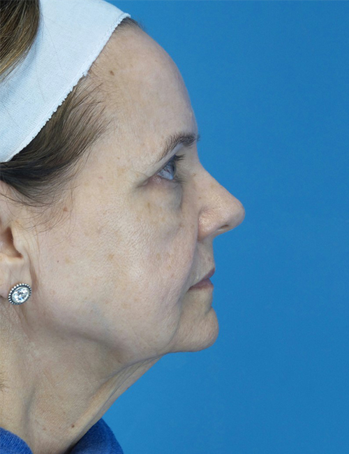 before facelift female patient right side view case 4416 | Crispin Plastic Surgery Atlanta, GA