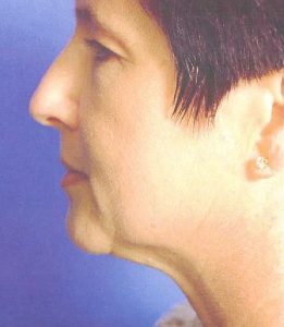 before facelift procedure female patient left side view case 4820 | Crispin Plastic Surgery Atlanta, GA