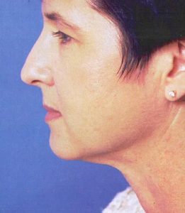 after facelift procedure female patient left side view case 4820 | Crispin Plastic Surgery Atlanta, GA