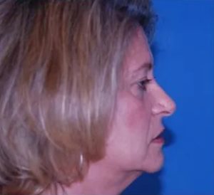 before facelift procedure right side view case 4844 | Crispin Plastic Surgery Atlanta, GA
