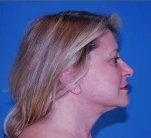 after facelift procedure right side view case 4844 | Crispin Plastic Surgery Atlanta, GA