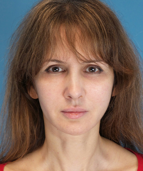 after mini facelift front view case 4847 | Crispin Plastic Surgery Atlanta, GA