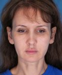 before mini facelift front view case 4847 | Crispin Plastic Surgery Atlanta, GA