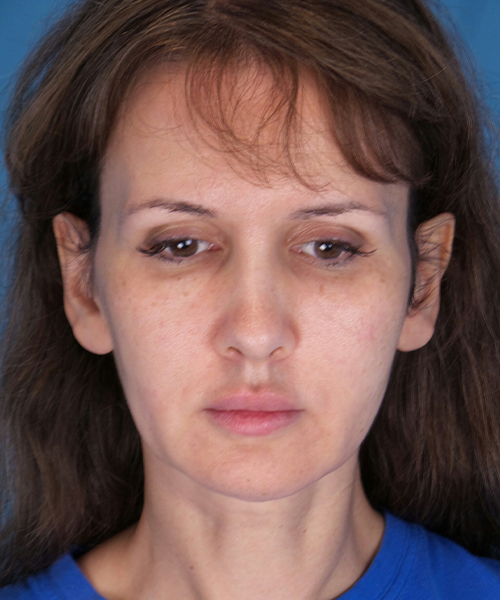 before mini facelift front view case 4847 | Crispin Plastic Surgery Atlanta, GA