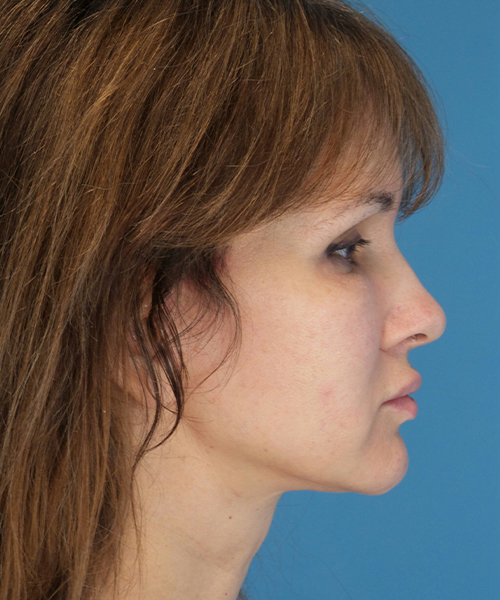 after mini facelift right side view case 4847 | Crispin Plastic Surgery Atlanta, GA