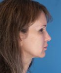 before mini facelift right side view case 4847 | Crispin Plastic Surgery Atlanta, GA