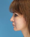 after mini facelift left side view case 4847 | Crispin Plastic Surgery Atlanta, GA